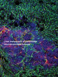 Liver metastasis of pancreatic neuroendocrine tumors